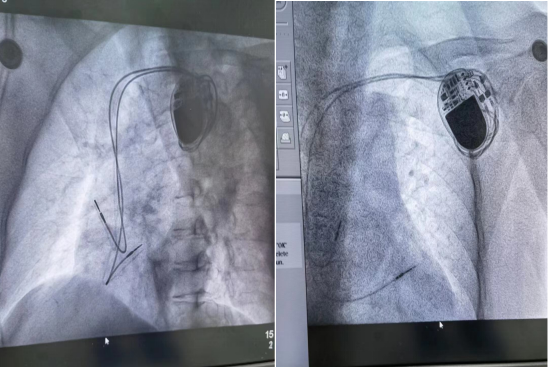 心脏起搏器安装术后造影图.png